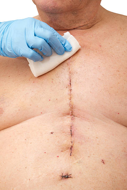 Heart Bypass surgery stock photo
