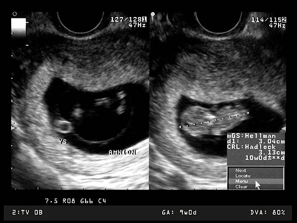 istock Ultrasound of 9 week old embryo 184304206
