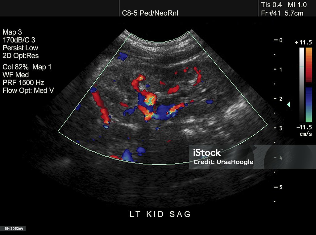 Doppler Ultraschall von Pediatric Kidney - Lizenzfrei Ultraschall-Untersuchung Stock-Foto