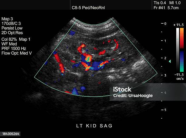 Photo libre de droit de Doppler Échographie De Rein En Pédiatrie banque d'images et plus d'images libres de droit de Échographie - Échographie, Système urinaire, Circulation sanguine