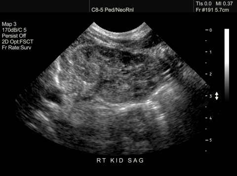 Ultrasound image of newborn right kidney in sagittal plane.