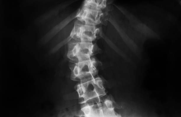 x-ray - scoliosis foto e immagini stock