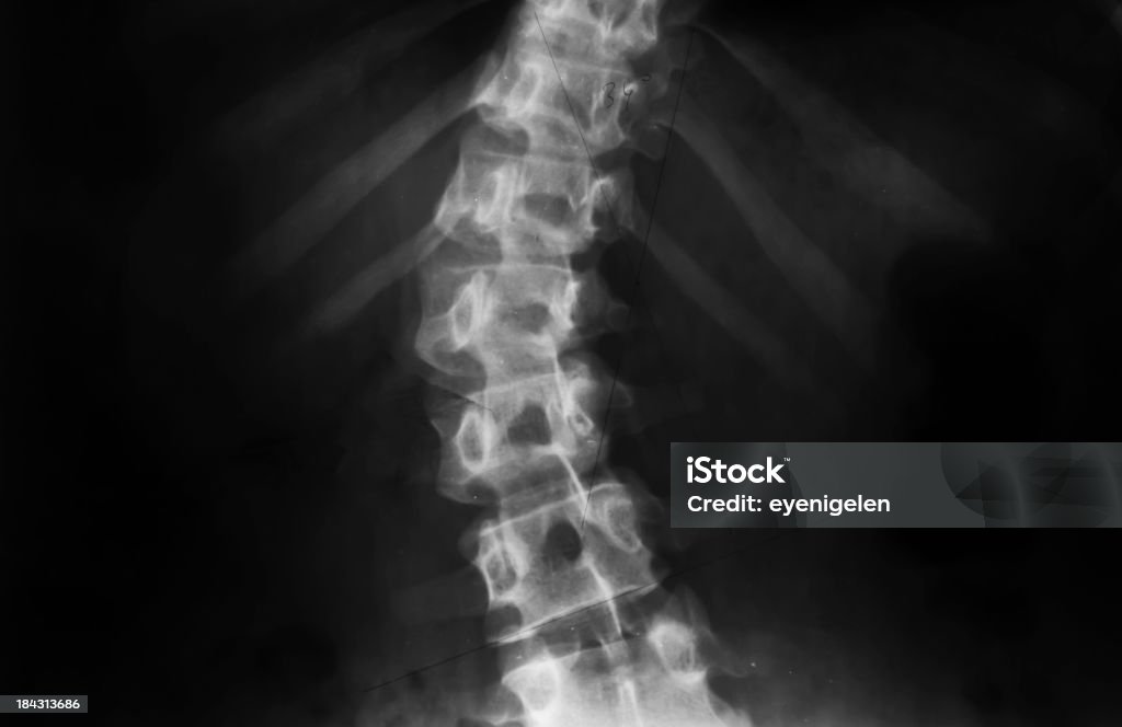 X 線 - 脊柱側弯症のロイヤリティフリーストックフォト