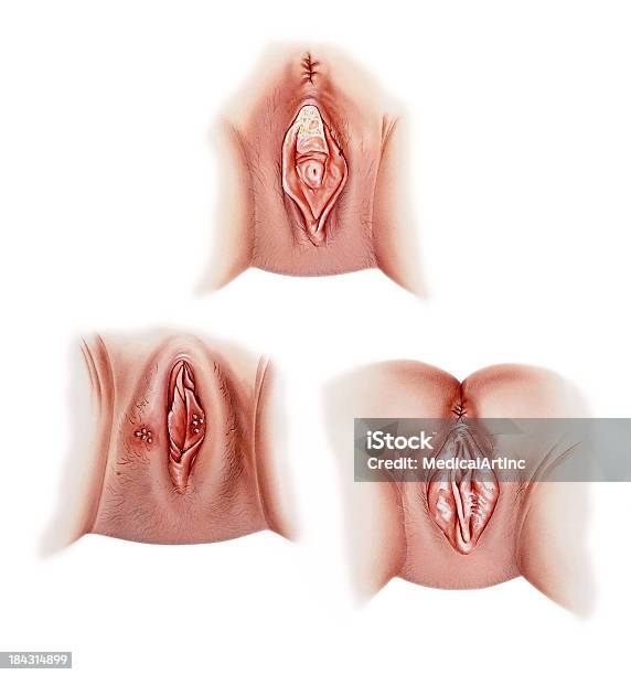 膣コモン症 - カンジダ酵母のベクターアート素材や画像を多数ご用意 - カンジダ酵母, 陰部ヘルペス, ヘルペス