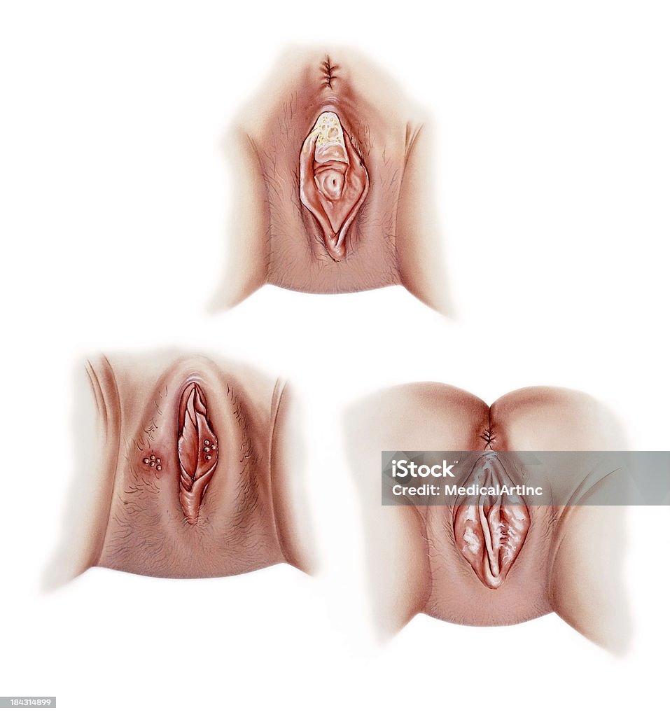 Vagina infecções-comum - Ilustração de Candidíase royalty-free