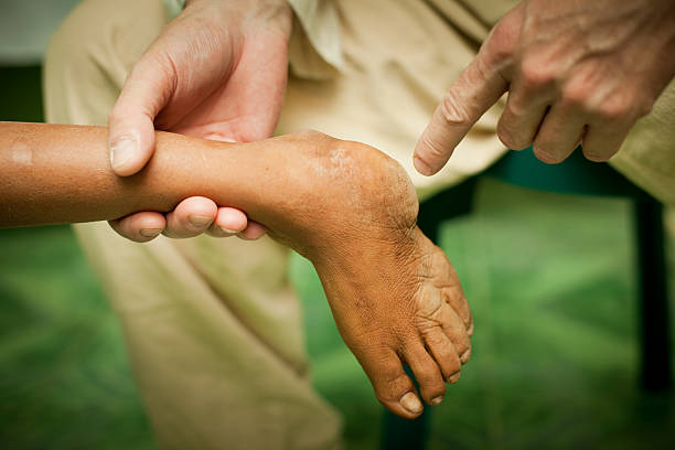 Doctor examining a deformed clubfoot stock photo