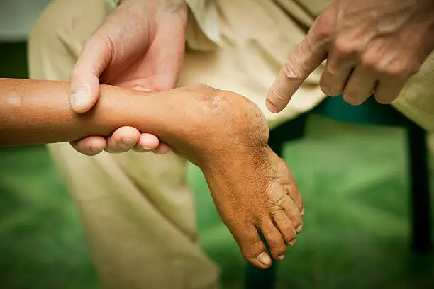 Doctor examining a deformed clubfoot