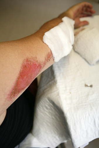 Road Rash Rib Cage Road Rash Vertical Stock Photo - Download Image Now - Adhesive Bandage ...
