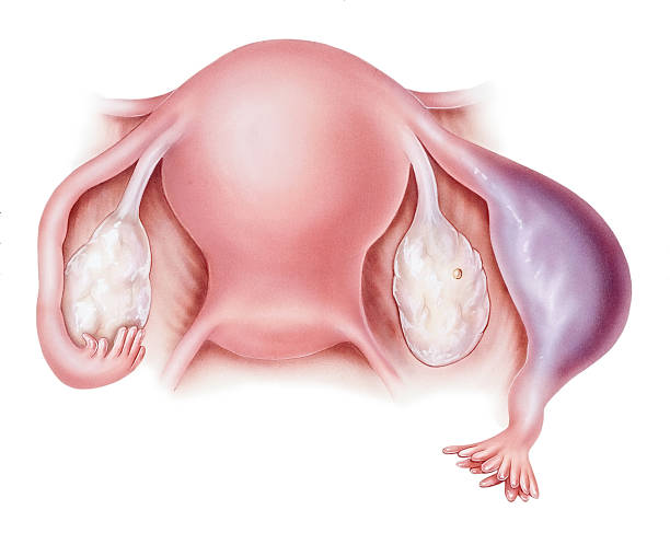 Pregnancy - Ectopic "An ectopic pregnancy. Shown are a normal fallopian tube (left) and an ectopic pregnancy in a fallopian tube (right). An ectopic pregnancy occurs when a fertilized egg attaches and begins to develop outside the uterus. Ectopic pregnancies occur in the fallopian tube, ovary, or cervix (other places are rare). Most spontaneously miscarry." fertilized egg stock illustrations