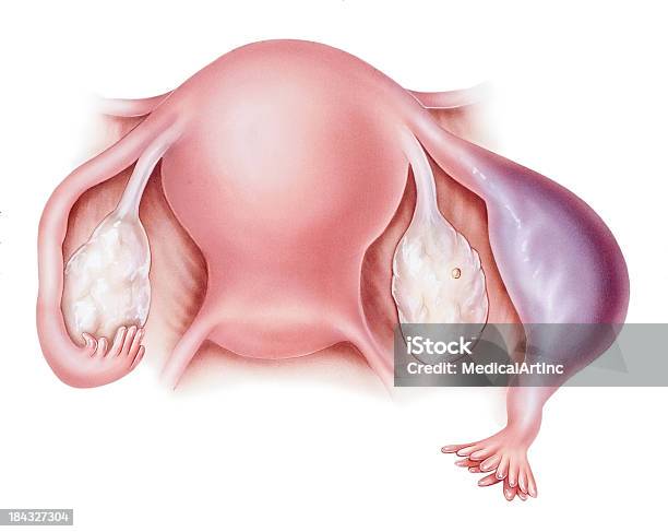 Pregnancy Ectopic Stock Illustration - Download Image Now - Ectopic Pregnancy, Human Zygote, Uterus