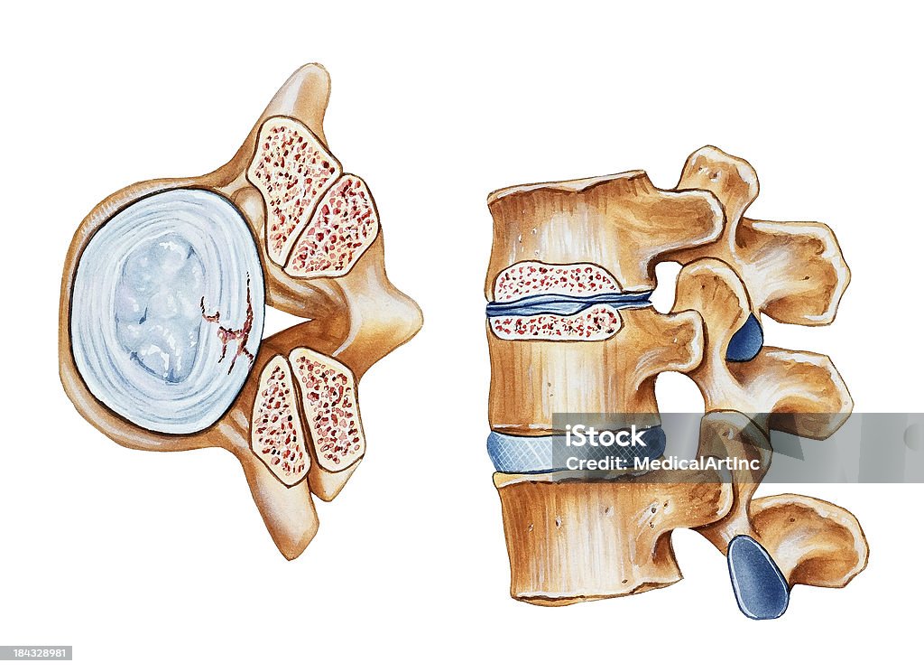 Позвоночник Стеноз позвоночного - Стоковые иллюстрации Стеноз роялти-фри