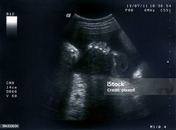 Ultrasound Of A Fetus 31 Weeks Stock Photo - Download Image Now - Macrophotography, Abdomen, Adult
