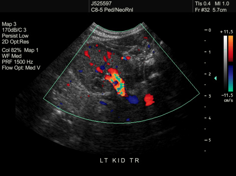 Transverse plane of left kidney of 4 day old newborn to determine blood flow in a dilated kidney.