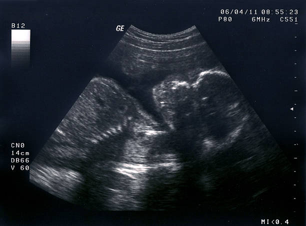 Échographie d'un Foetus de 16 semaines, - Photo