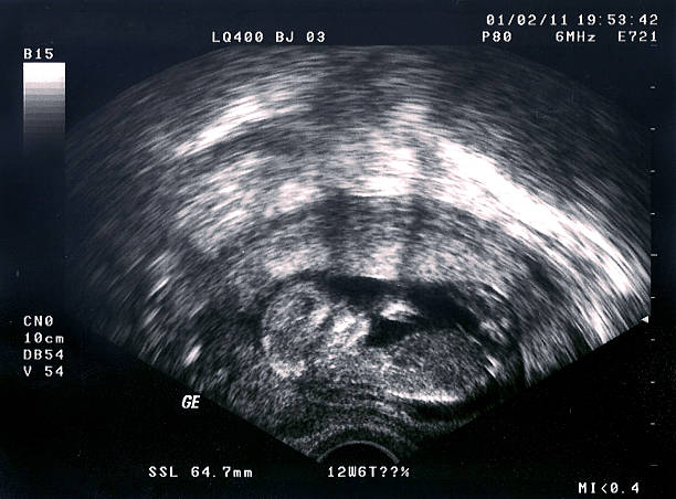 超音波、fetus 、12 週間 ストックフォト