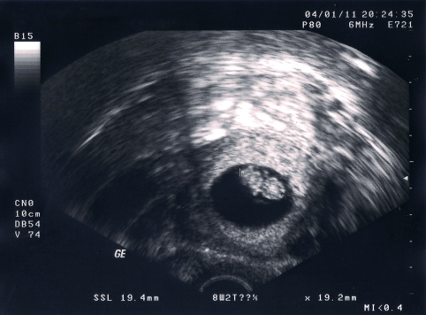 Highres scan of an ultrasonic of a zygote or embryo in a very early stage 8 weeks oldSee the whole series of fetal development stage by stage: