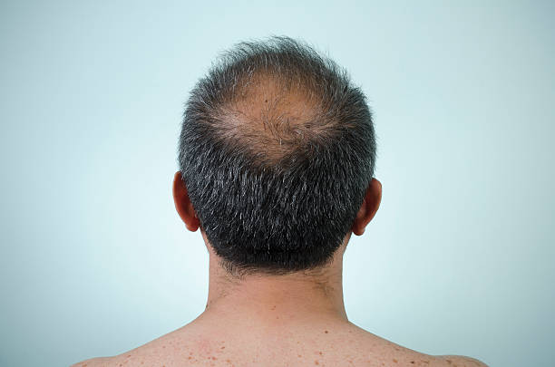 The back view of a man's head who is balding Balding, to become bald balding stock pictures, royalty-free photos & images