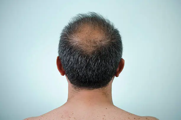 Photo of The back view of a man's head who is balding