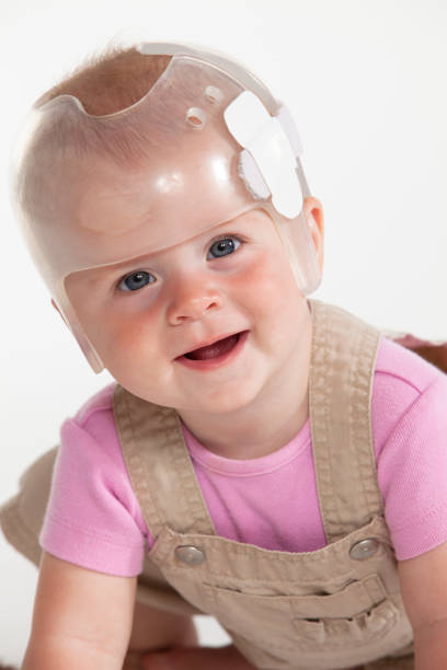 A cute baby wearing a transparent helmet Baby girl wearing a helmet for treatment of plagiocephaly plagiocephaly stock pictures, royalty-free photos & images