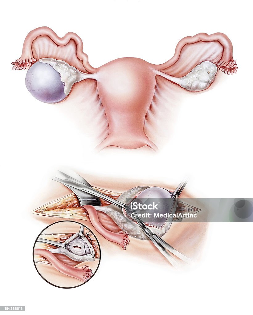 난소-방광절제술 - 로열티 프리 난소 낭종 스톡 일러스트