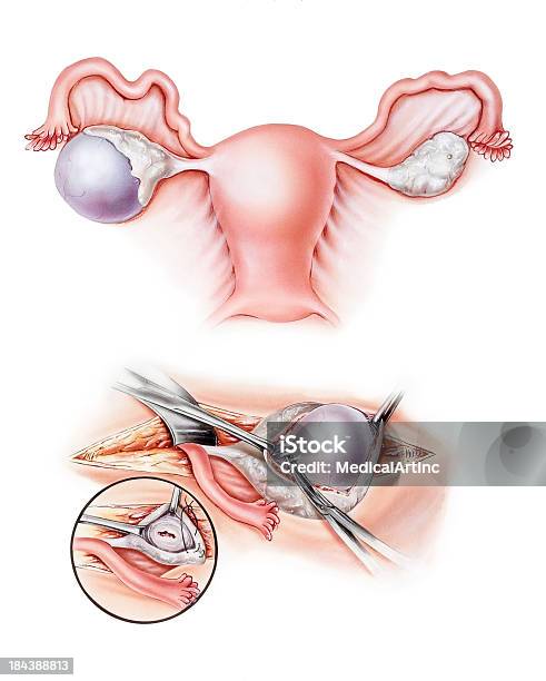 Ovárioscystectomy - Arte vetorial de stock e mais imagens de Quisto nos ovários - Quisto nos ovários, Ovário, Quisto