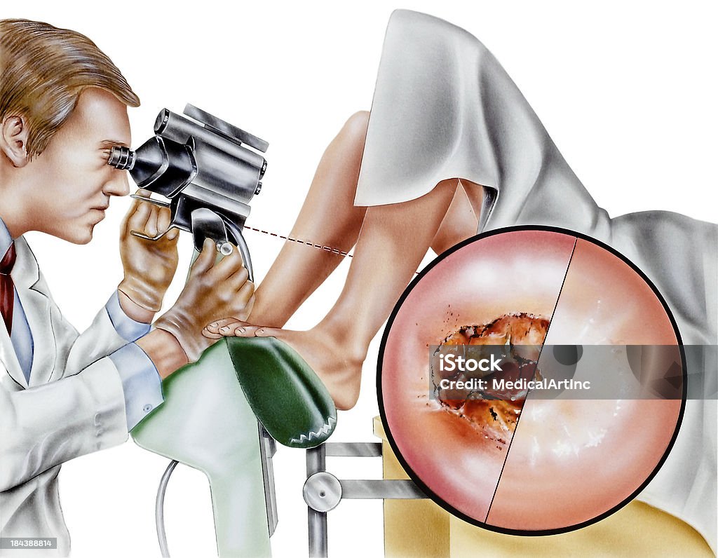 Útero: Cervical cirugía láser - Ilustración de stock de Cuello del útero libre de derechos