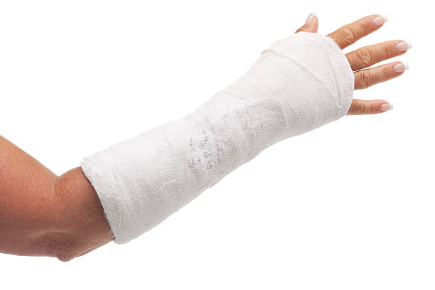 cast arm female forearm in cast isolated on white orthopedic cast stock pictures, royalty-free photos & images