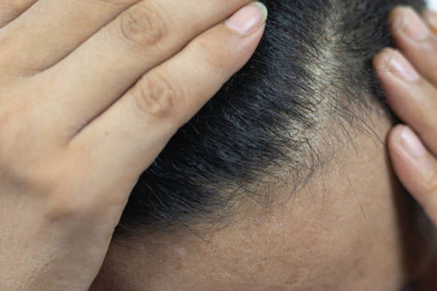 istock Close Up Young people have problems with hair loss, dryness, dullness, split ends and damage. 1844222427