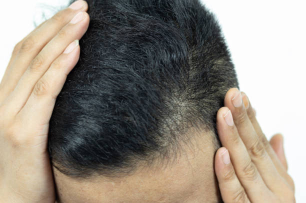istock Close Up Young people have problems with hair loss, dryness, dullness, split ends and damage. 1844222962
