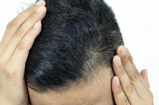 Close Up Young people have problems with hair loss, dryness, dullness, split ends and damage.