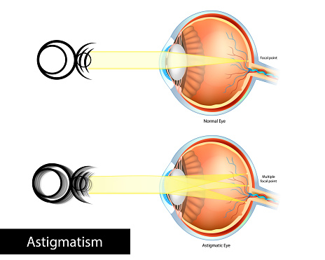 Astigmatic Eye and Normal Eye. Astigmatism, refractive or refraction error. Blurred, or distorted vision. Multiple Focal point