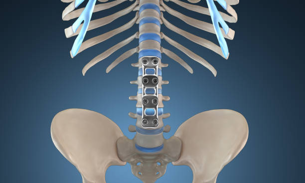 istock Orthopedic Spine Fixation Spinal Fixator Anterior Lumbar plate 1845530730