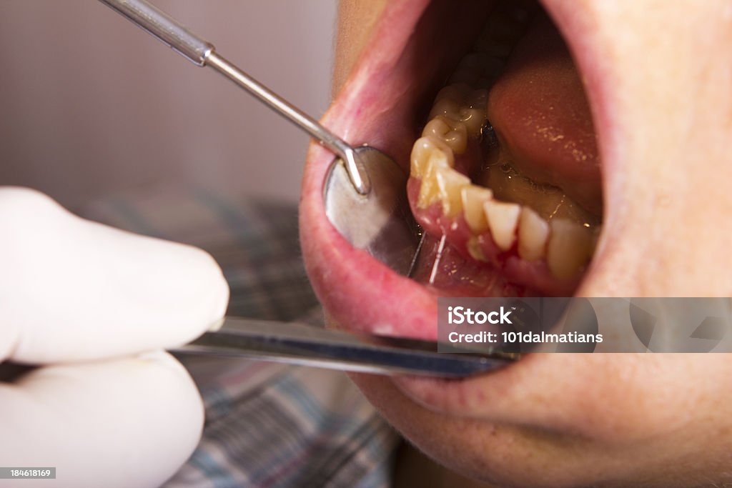 Problema de Placa Dentária - Royalty-free Gengiva Foto de stock