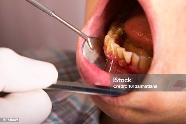 Problema De Placa Dentária - Fotografias de stock e mais imagens de Gengiva - Gengiva, Sangue, Aberto