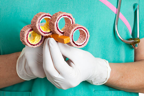 Atherosclerosis Nurse holding anatomical model of arteries showing normal artery and different stages of arterosclerosis. blood clot photos stock pictures, royalty-free photos & images