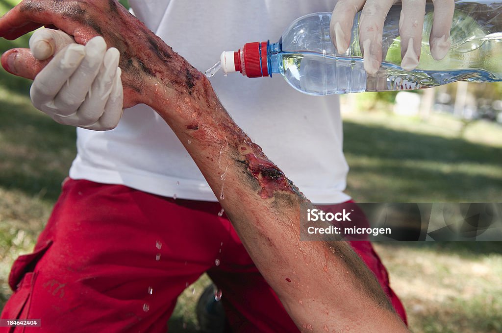 Third degree burns "Paramedic cooling third degree hand burns with water. Simulated exercise, professional medical make-up, not a real injury." Burning Stock Photo