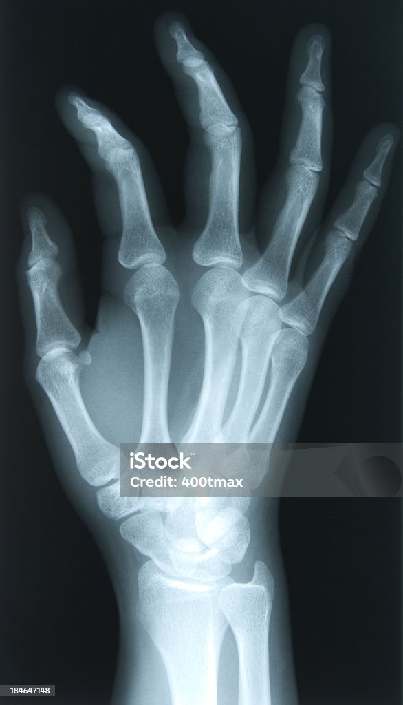 X-ray of 24 Jahre alte Frauen mit der rechten hand - Lizenzfrei Alterungsprozess Stock-Foto