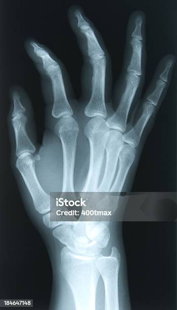 Xray Of 24 Jahre Alte Frauen Mit Der Rechten Hand Stockfoto und mehr Bilder von Alterungsprozess - Alterungsprozess, Anatomie, Arthritis