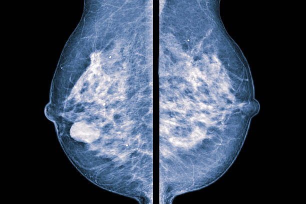 comparative mammogram billateral mammogram breast photos stock pictures, royalty-free photos & images