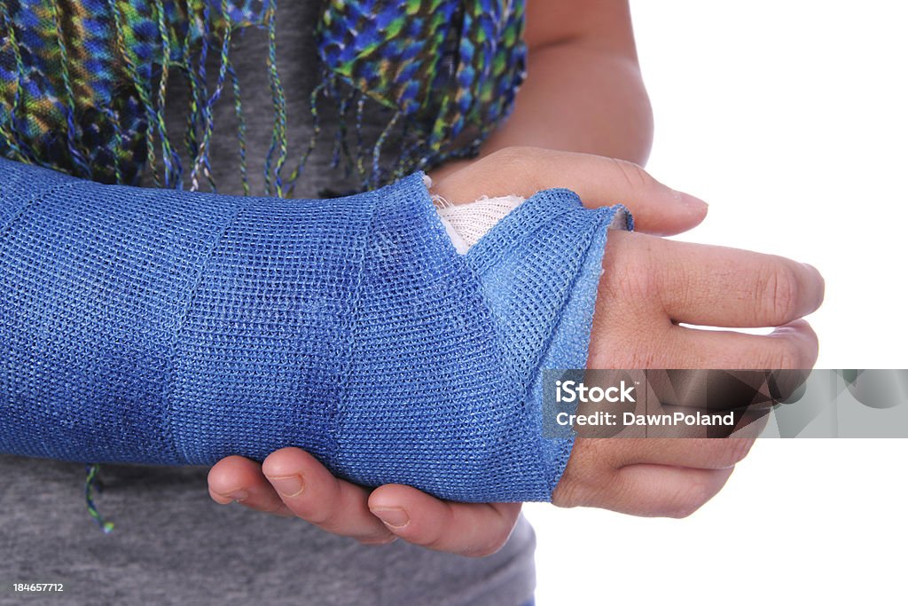 Broken poignet - Photo de Plâtre - Équipement orthopédique libre de droits