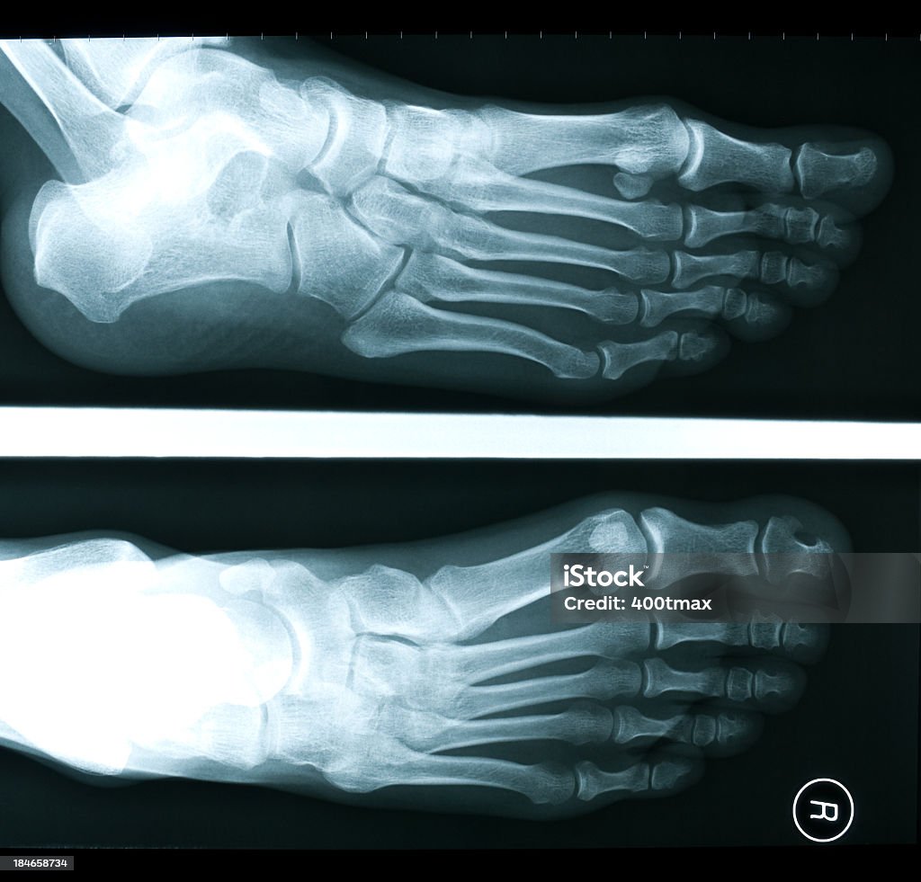 X-ray of 28 year old female foot X-ray of a 28 year old female human foot illuminated by a light box. Aging Process Stock Photo