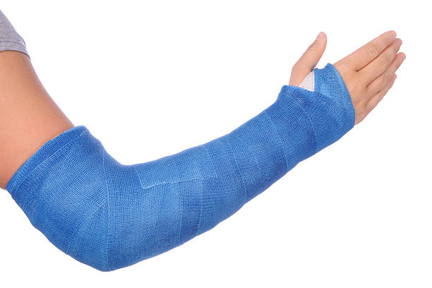 Broken Arm Broken arm with a blue fiberglass cast on a white background.PLEASE CLICK ON THE IMAGE BELOW TO SEE MY MEDICAL TECHNOLOGY LIGHTBOX: orthopedic cast stock pictures, royalty-free photos & images