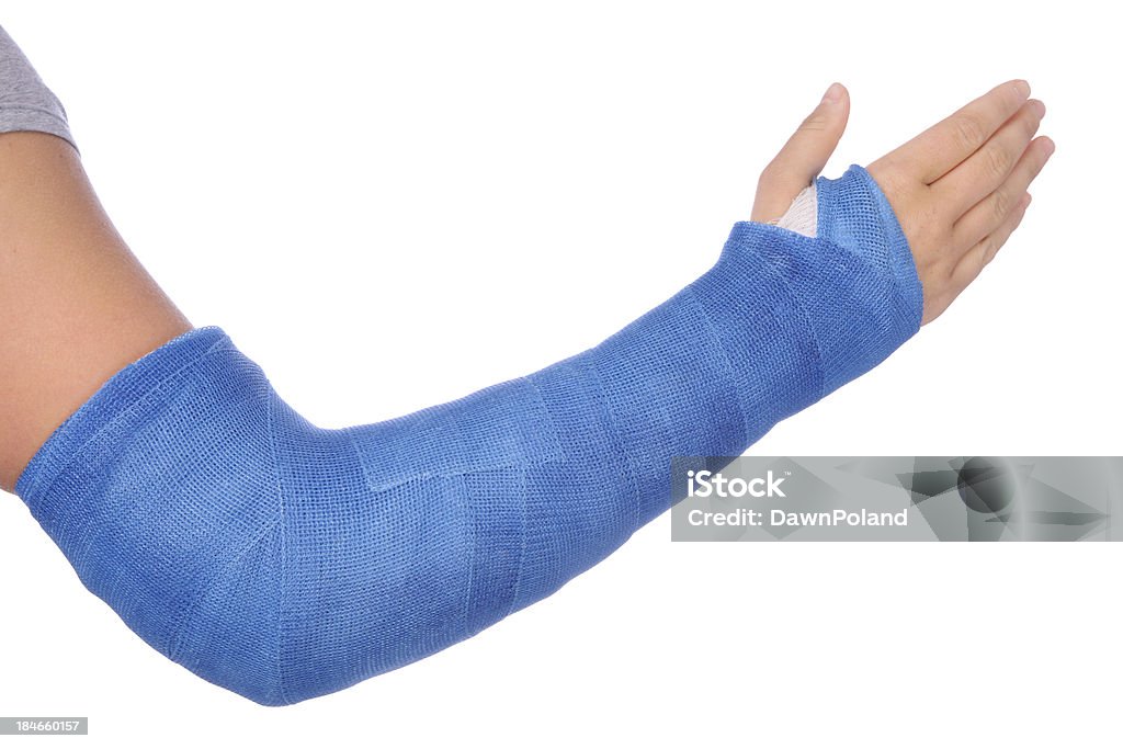 Сломанная рука - Стоковые фото Гипсовая повязка роялти-фри