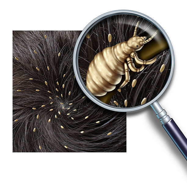 Lice Problem Lice problem as a medical concept of a magnifying glass close up of a human head with an infestation of parasitic nits or eggs hatching from a louse insect as a symbol of diagnosis prevention and treatment for children and adults. parasite infestation stock pictures, royalty-free photos & images