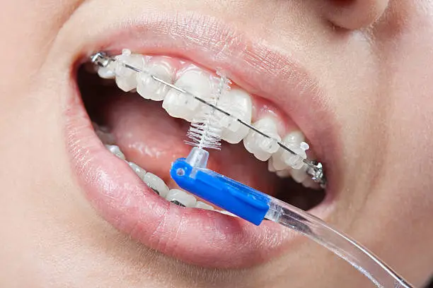 Brushing your teeth with braces.toothbrush.white Teeth