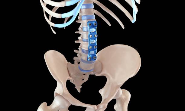 istock Orthopedic Spine Fixation Spinal Fixator Anterior Lumbar plate 1847325295