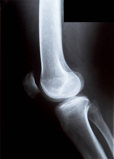 joelho raio-x - healthcare and medicine the human body x ray image human bone - fotografias e filmes do acervo