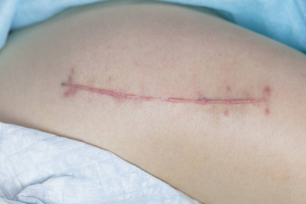 à quoi ressemble la suture 2 mois après une arthroplastie totale de la hanche, gros plan - two party system photos et images de collection