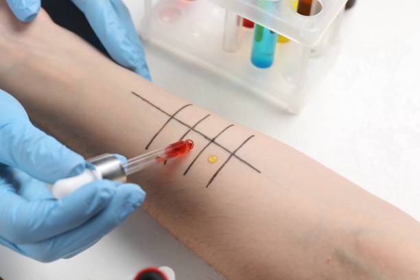 istock Doctor doing skin allergy test at light table, closeup 1848172809
