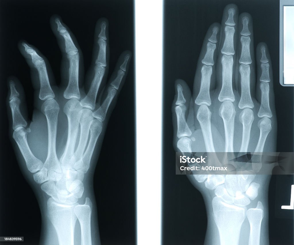 X-ray z kobieta 24 lat's prawej ręce - Zbiór zdjęć royalty-free (Złamanie)